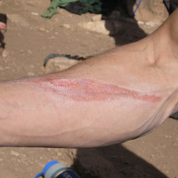 Veja como tratar queimaduras provocadas por cordas em quedas durante a escalada