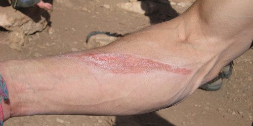 Veja como tratar queimaduras provocadas por cordas em quedas durante a escalada