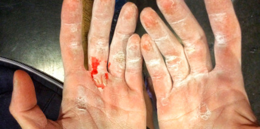 Mãos e dedos esfolados: Quais são os remédios naturais para recuperar a pele